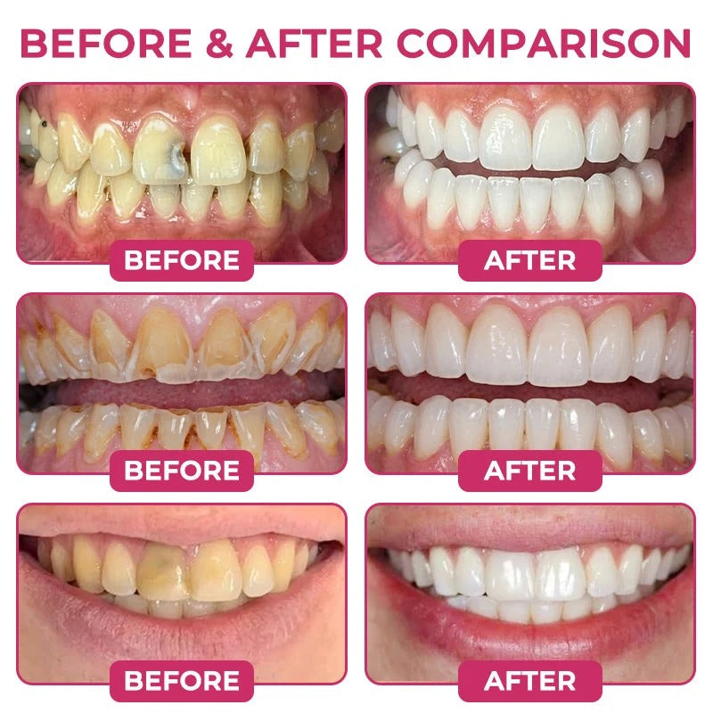 Cavity-Repair Natural Enamel Filling Gel